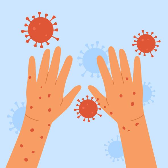 Measles